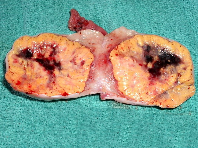 Ovary_Steroid Cell Tumor1A.jpg